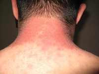 Vücutta Kabarma Belirtileri ve Tedavisi